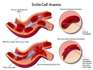 Historia Natural de la Anemia-1-min