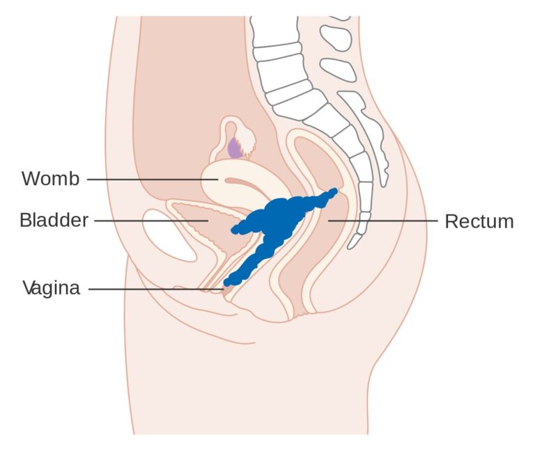 Historia Natural de la Emfermedad Cancer Cervicouterino-2-min